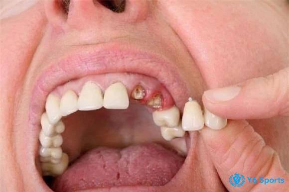 Giấc mơ thấy gãy răng mang đến cho bạn nhiều con số may mắn trong cuộc sống